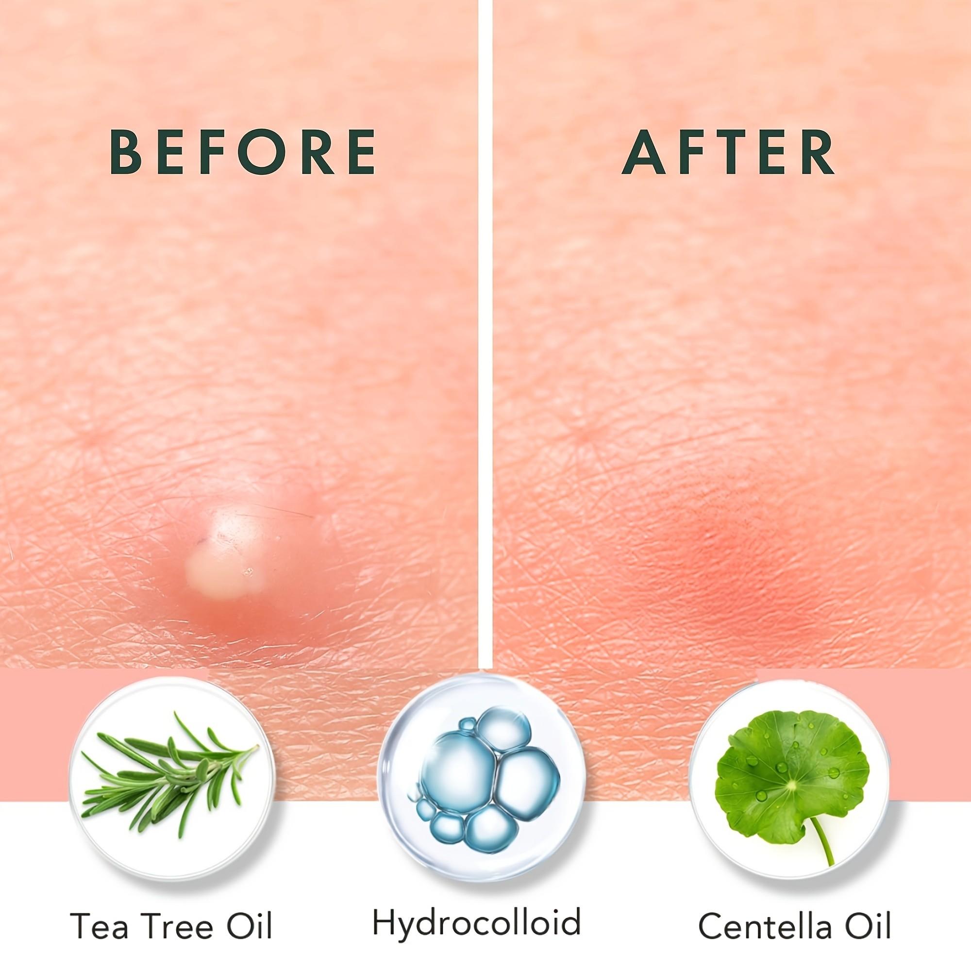 180/360/720 cerotti per l'acne - Skincare Oil Control recensione e prezzo